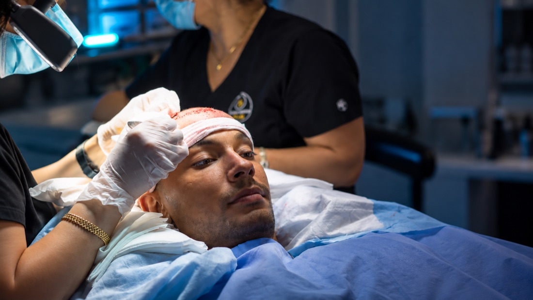 DHI hair transplant procedure in progress at Nova Medical New Jersey, technician placing grafts along the hairline
