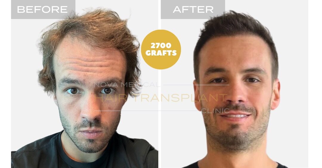 DHI Hair Transplant Before and After - Patient 1, Nova Medical