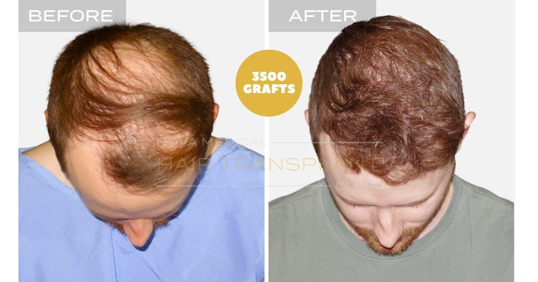 DHI Hair Transplant Before and After - Patient 2, Nova Medical