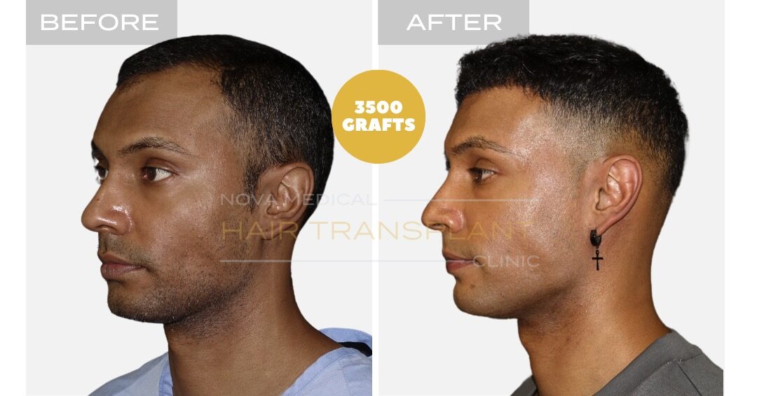 DHI Hair Transplant Before and After - Patient 3, Nova Medical