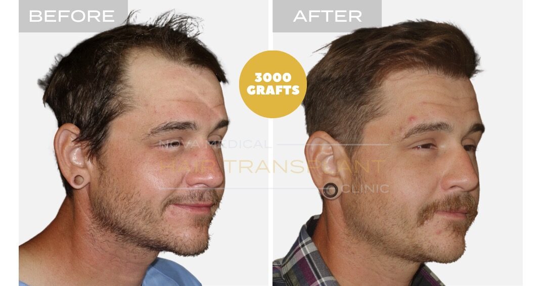 DHI Hair Transplant Before and After - Patient 4, Nova Medical