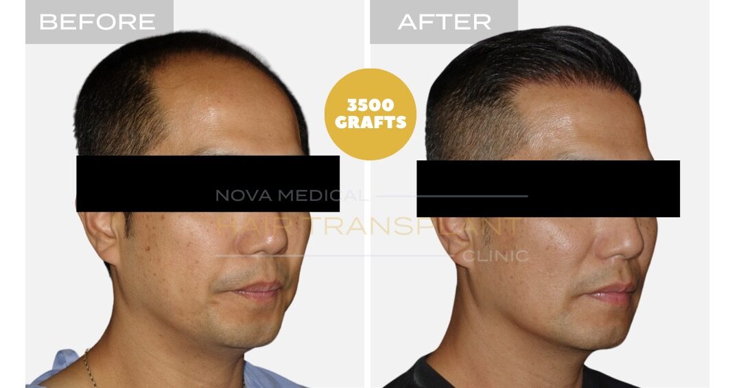 DHI Hair Transplant Before and After - Patient 5, Nova Medical