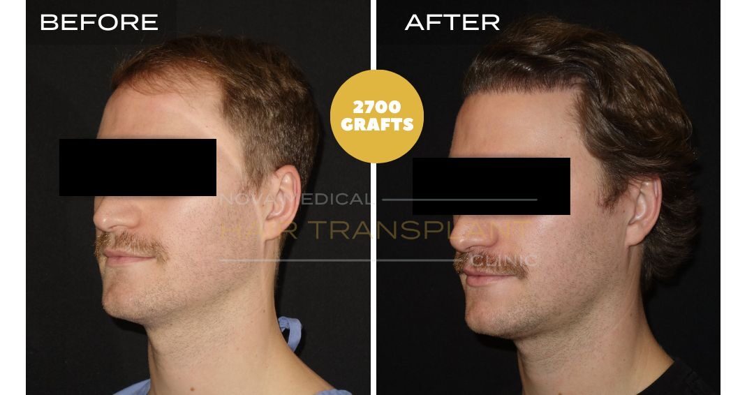DHI Hair Transplant Before and After - Patient 5 angle 2, Nova Medical