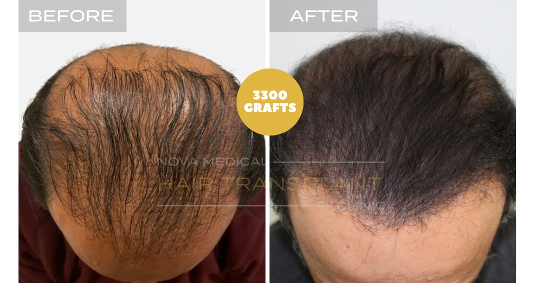 Hair transplant before and after