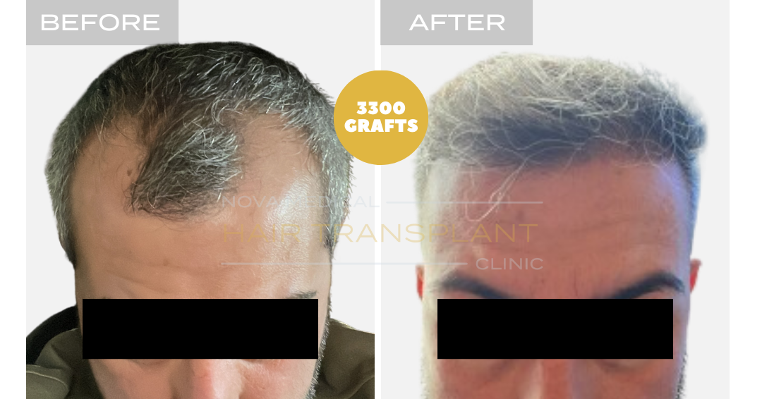 Hair transplant before and after