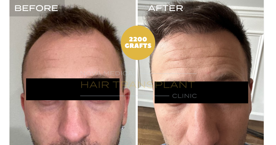Hair transplant before and after