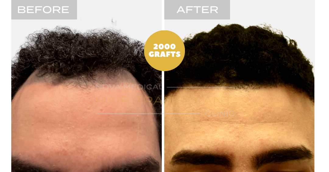 Hair transplant before and after