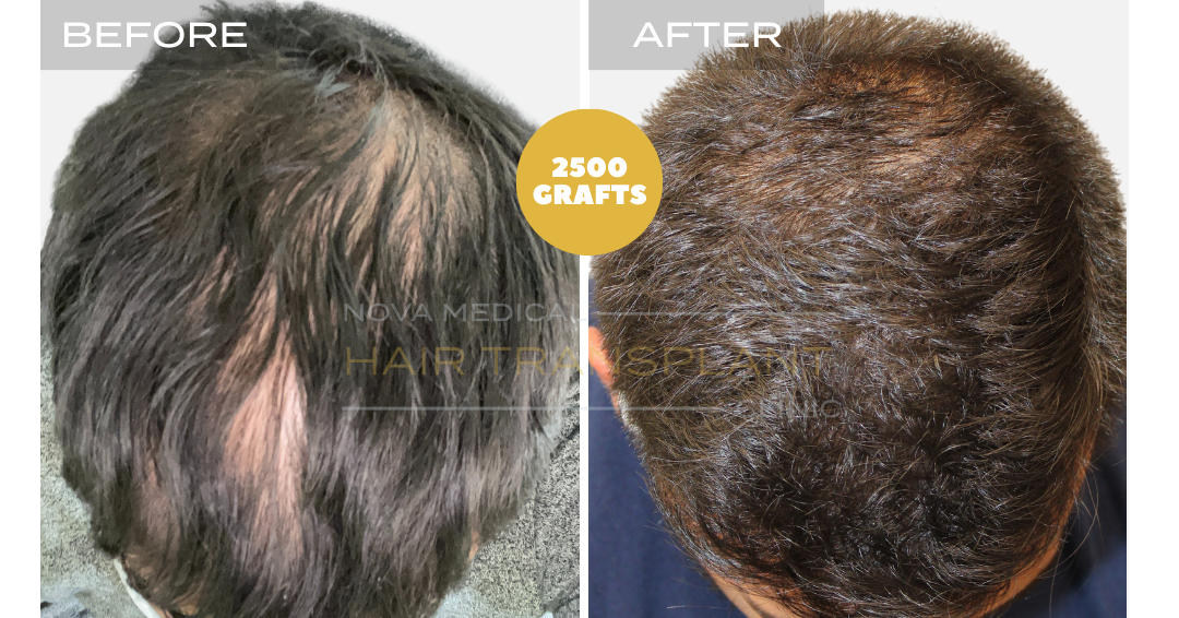 Hair transplant before and after