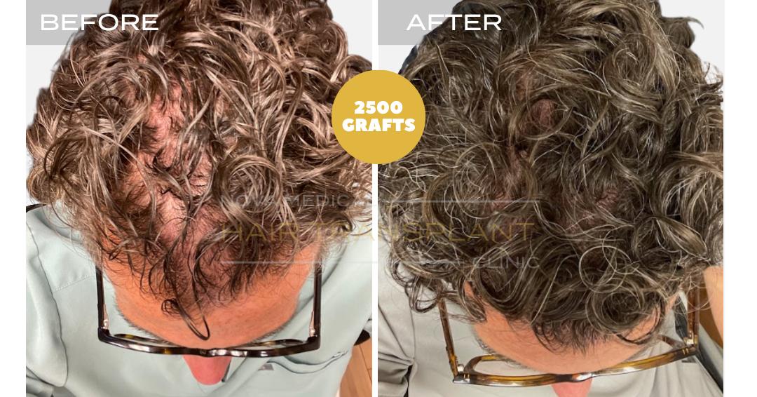 Hair transplant before and after