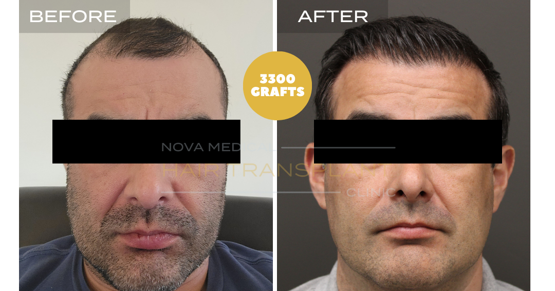 Hair transplant before and after