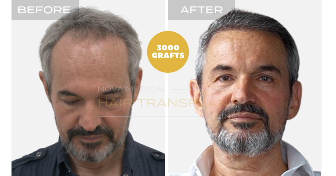 Hair transplant before and after