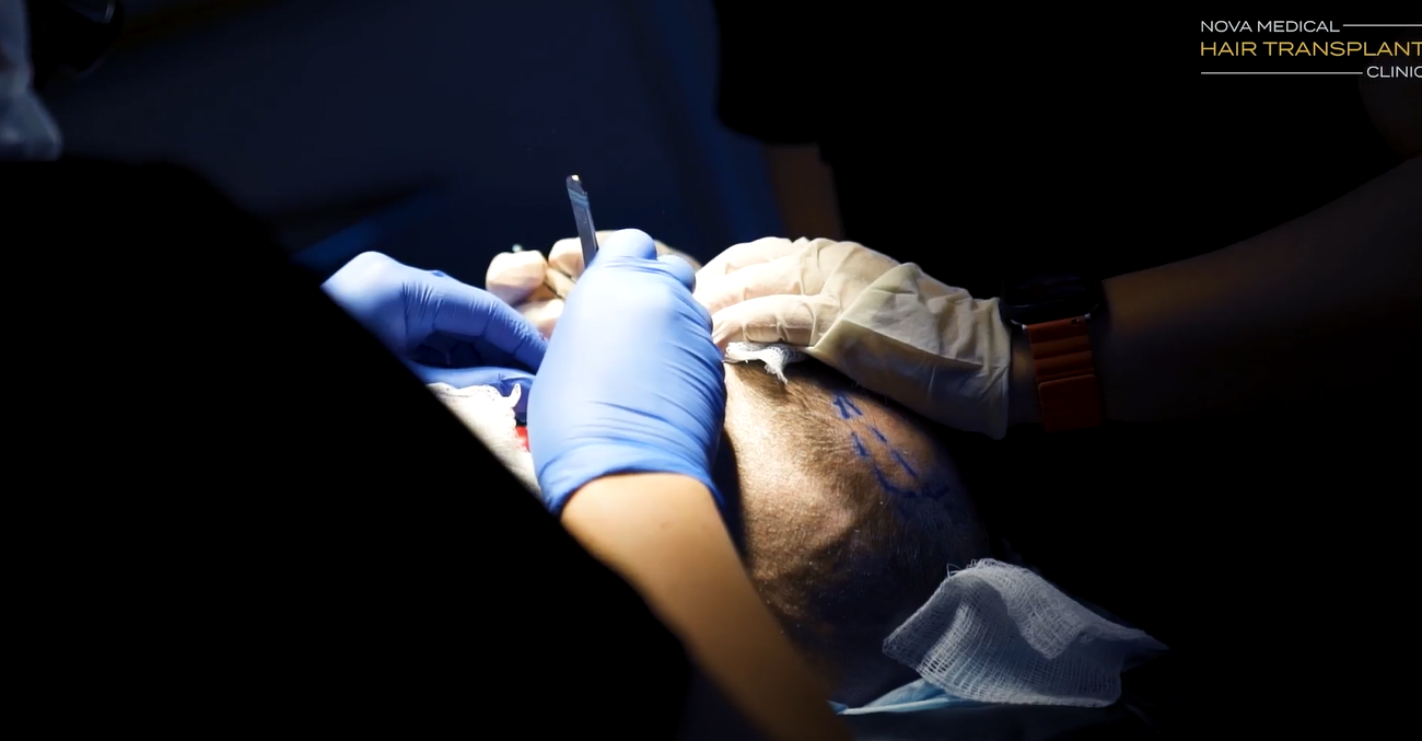 hair transplant new jersey