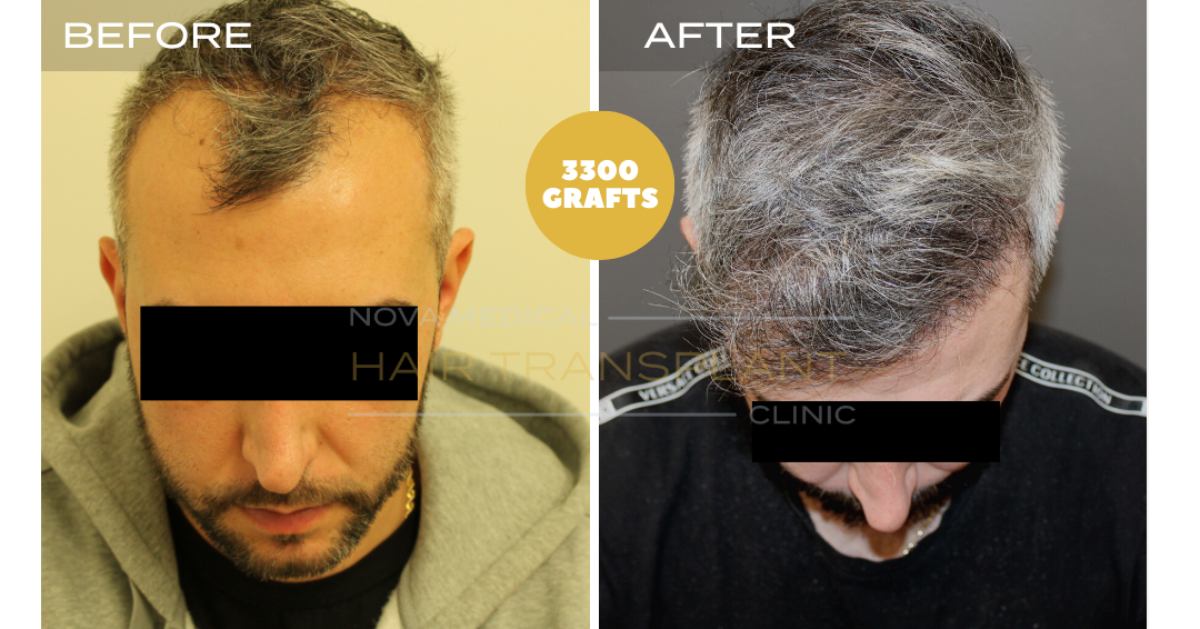 Hair transplant before and after