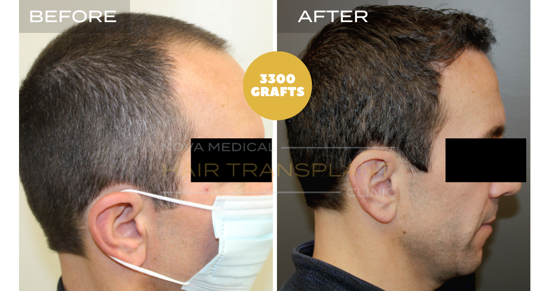 Hair transplant before and after