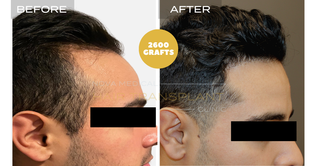 Hair transplant before and after