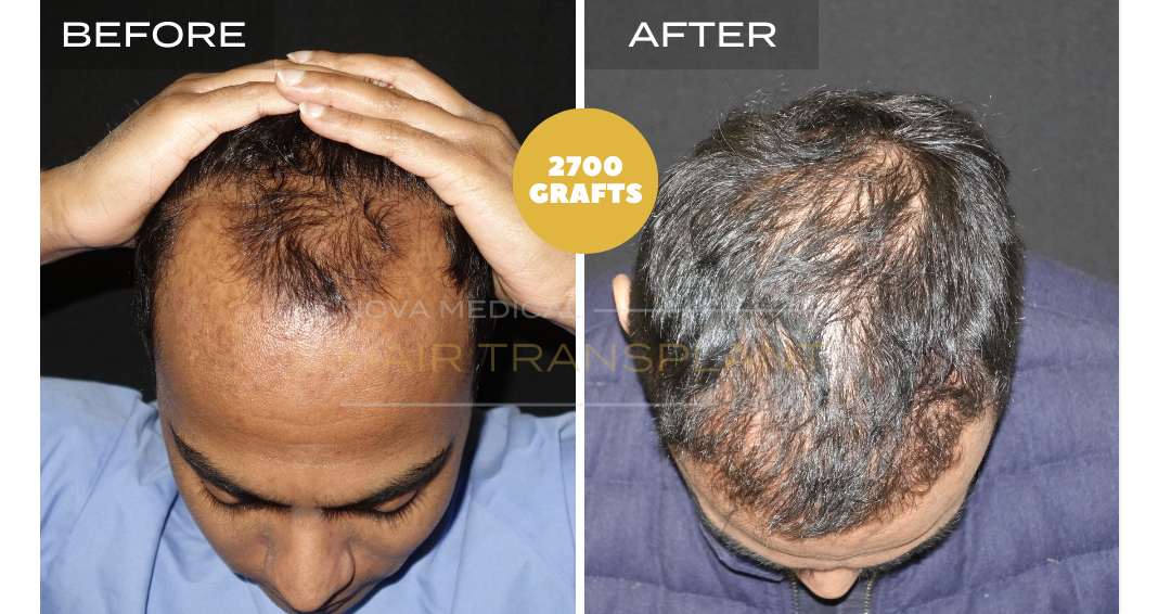 Hair transplant before and after