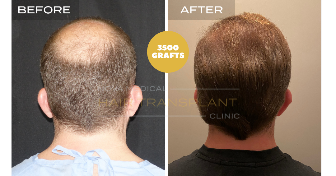 Hair transplant before and after