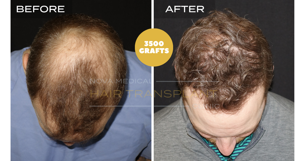 Hair transplant before and after