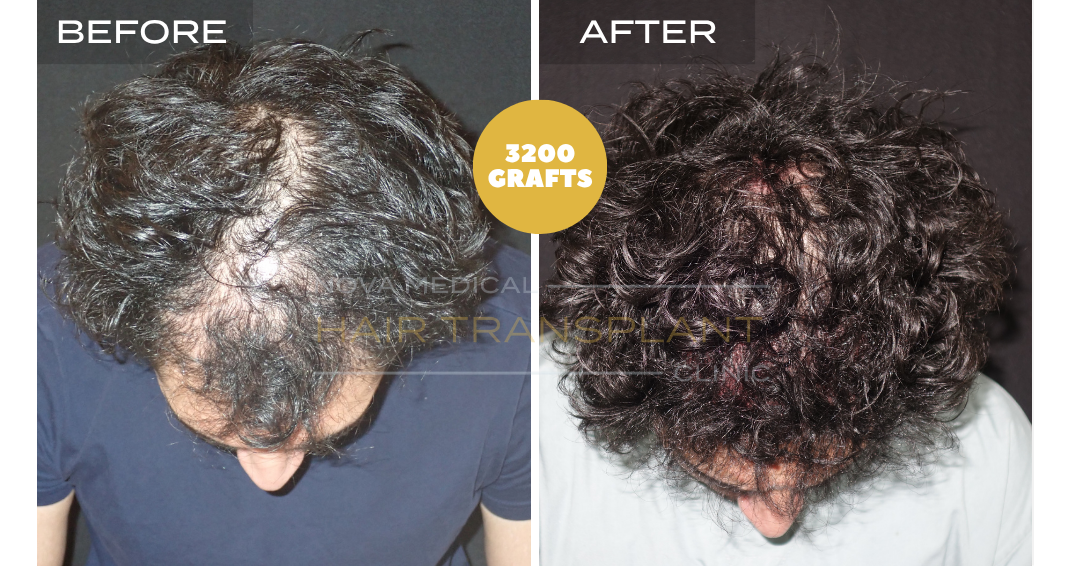 Hair transplant before and after
