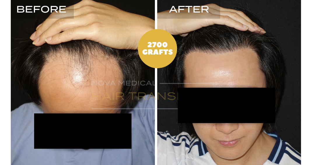 Hair transplant before and after